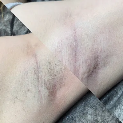 Sugaring Elektroepilacja Waxing Laser Katowice Epil by AV